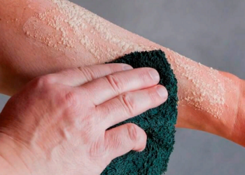 How to clean the burn