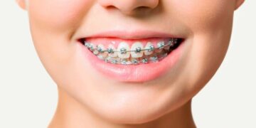 Брекет системы: ключевые достоинства, особенности и правила установки