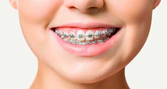 Брекет системы: ключевые достоинства, особенности и правила установки